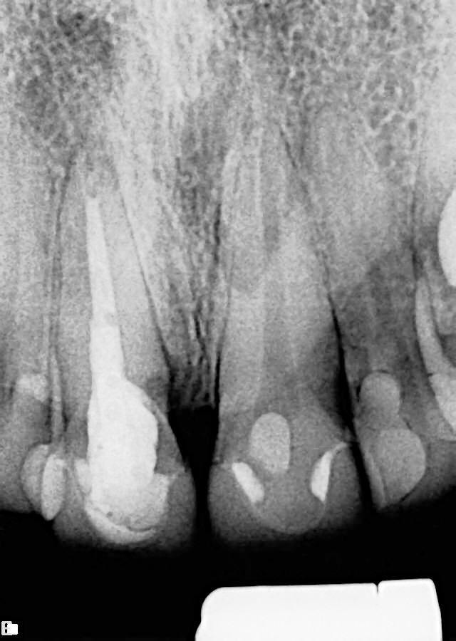 Immediate Implant Placement — Case 3 — case 1