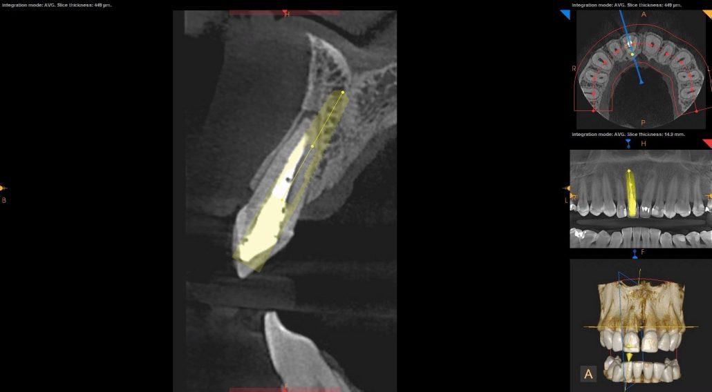 Immediate Implant Placement — Case 3 — case 2