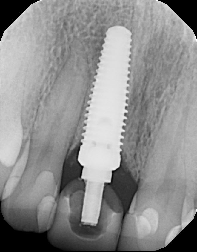 Immediate Implant Placement — Case 3 — case 3