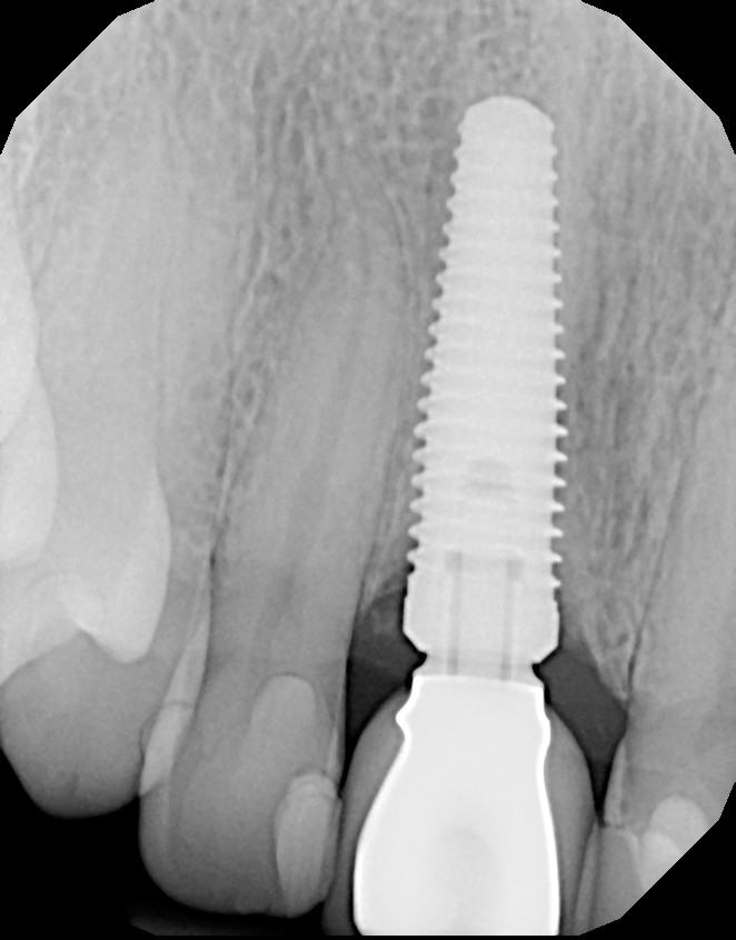 Immediate Implant Placement — Case 3 — case 4