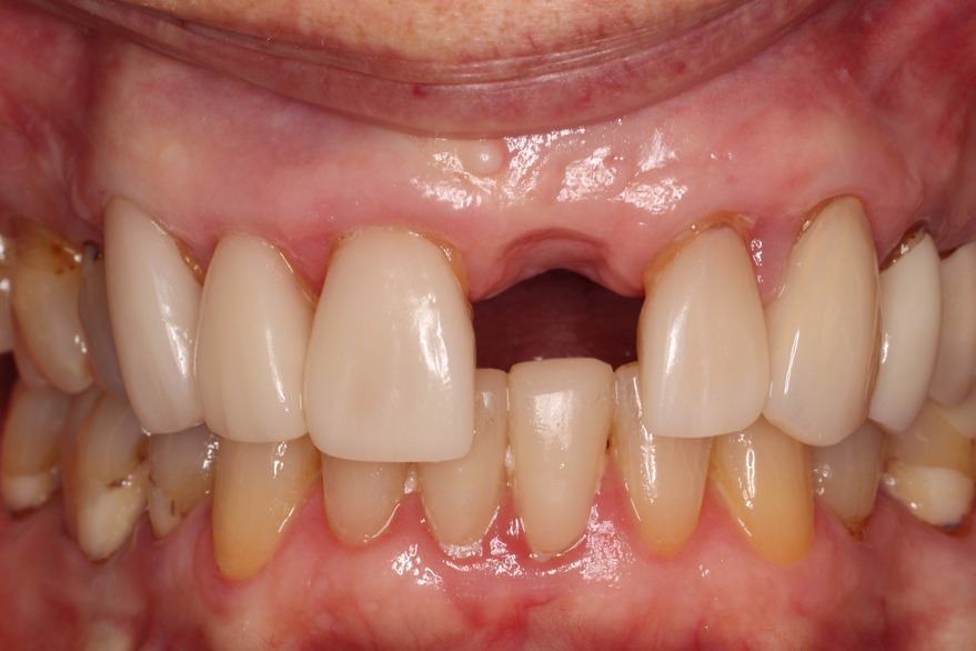 Immediate Implant on Tooth #9 — before