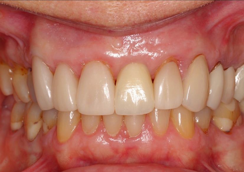 Immediate Implant on Tooth #9 — after