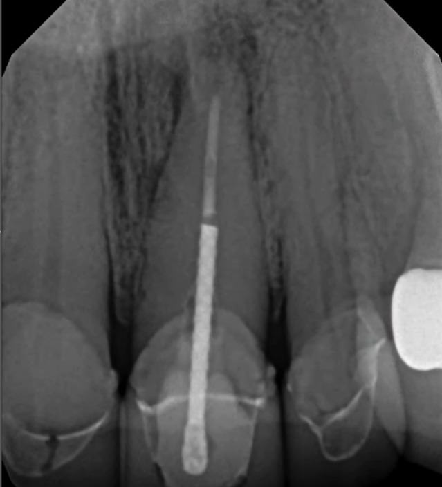 Immediate Implant Placement — Case 4 — case 3