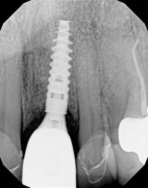 Immediate Implant Placement — Case 4 — case 4