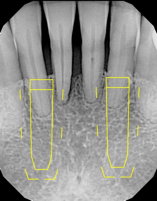 Immediate Implants and Temporary Bridge — before & after case 1