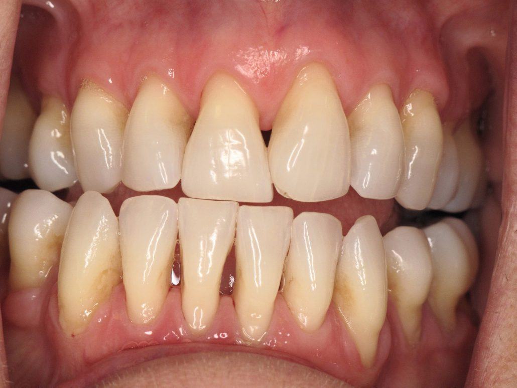 Immediate Implants and Temporary Bridge — before & after case 2