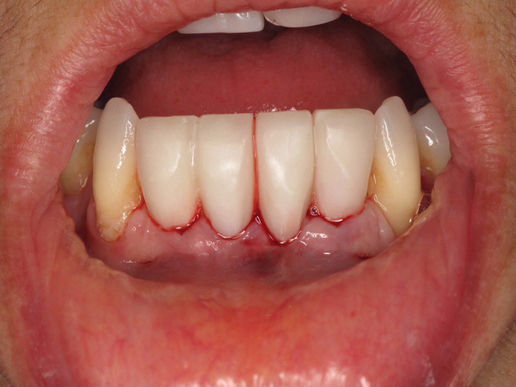 Immediate Implants and Temporary Bridge — before & after case 3