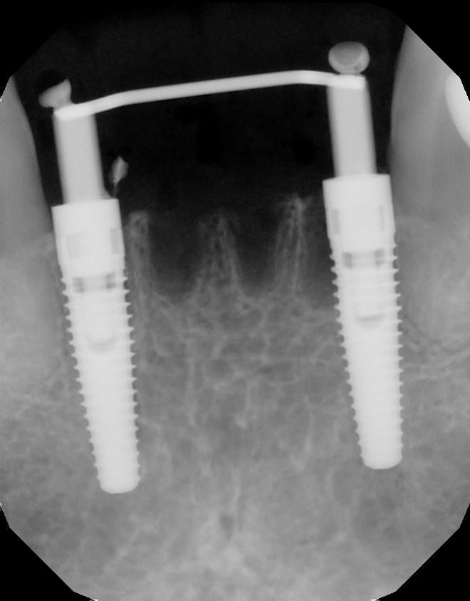 Immediate Implants and Temporary Bridge — before & after case 4