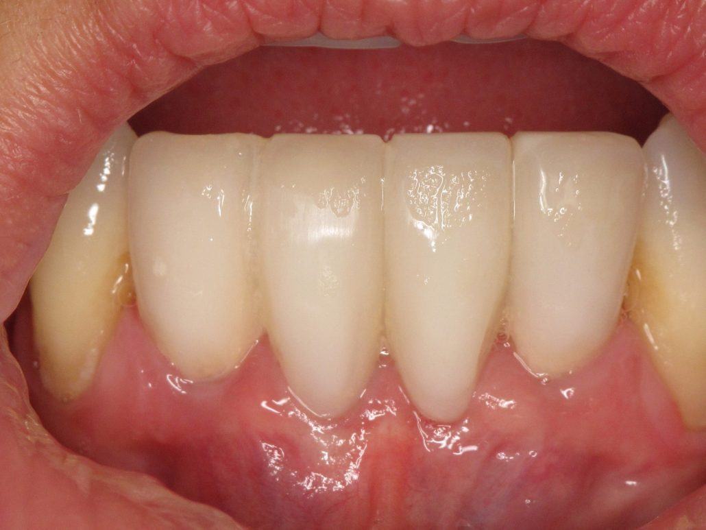 Immediate Implants and Temporary Bridge — before & after case 5