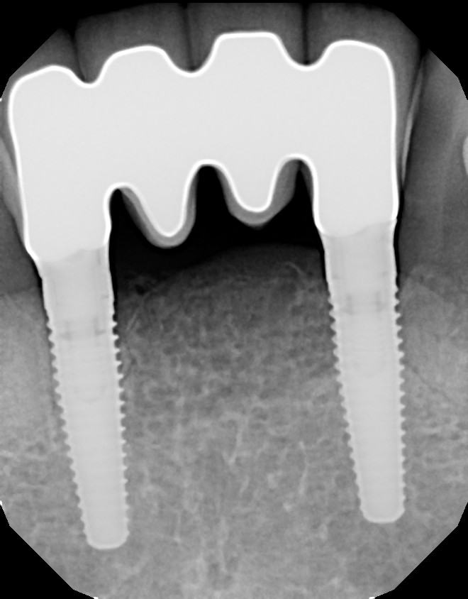 Immediate Implants and Temporary Bridge — before & after case 6