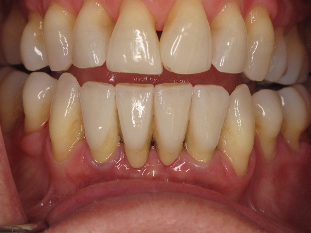 Immediate Implants and Temporary Bridge — before & after case 7