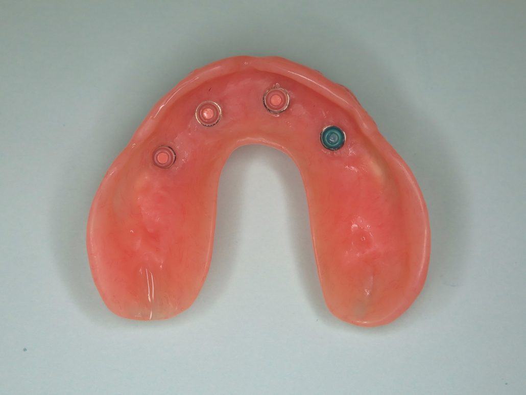 Maxillary Locator Overdenture — before & after case 1