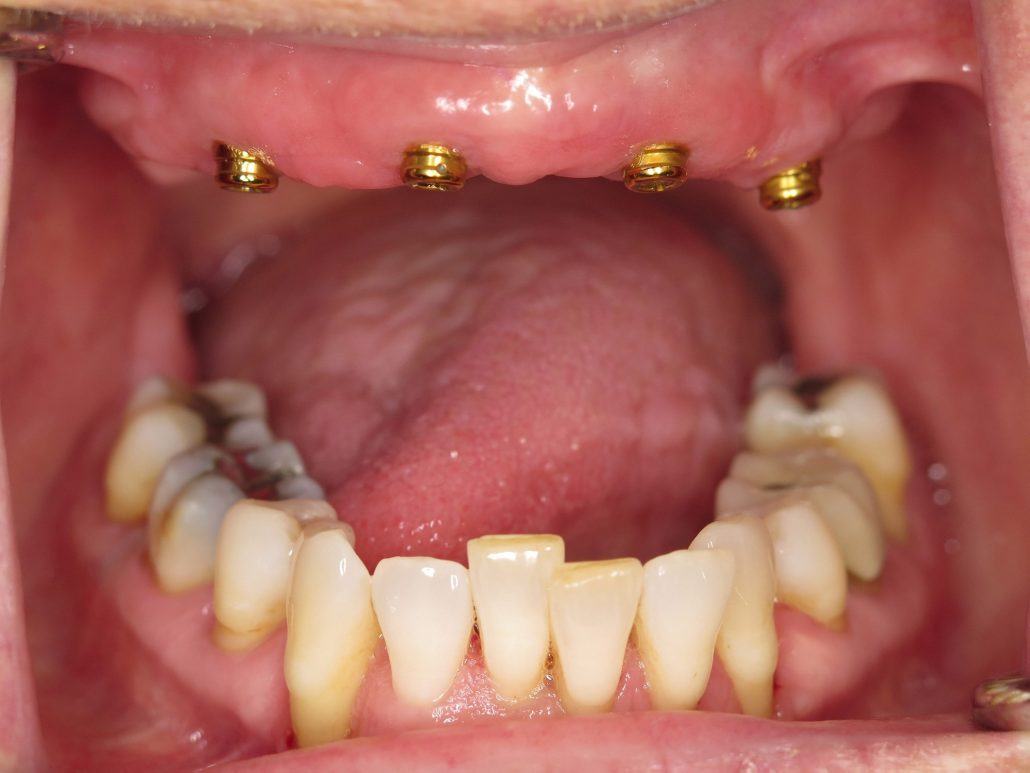 Maxillary Locator Overdenture — before & after case 2