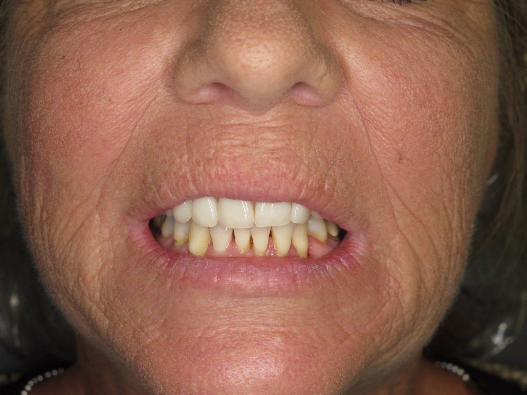 Maxillary Locator Overdenture — before & after case 3