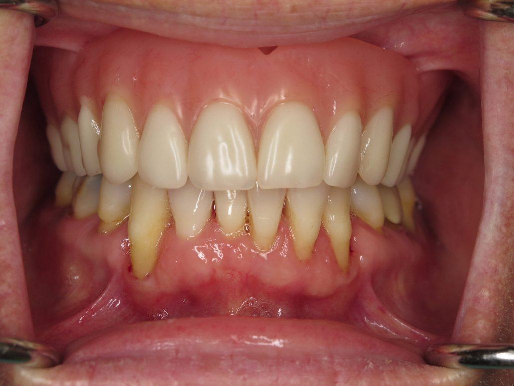 Maxillary Locator Overdenture — before & after case 4