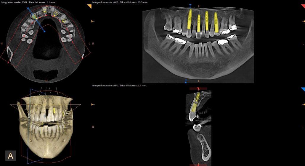 Maxillary Locator Overdenture — before & after case 5