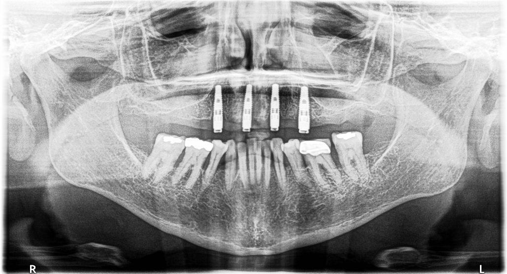 Maxillary Locator Overdenture — before & after case 6