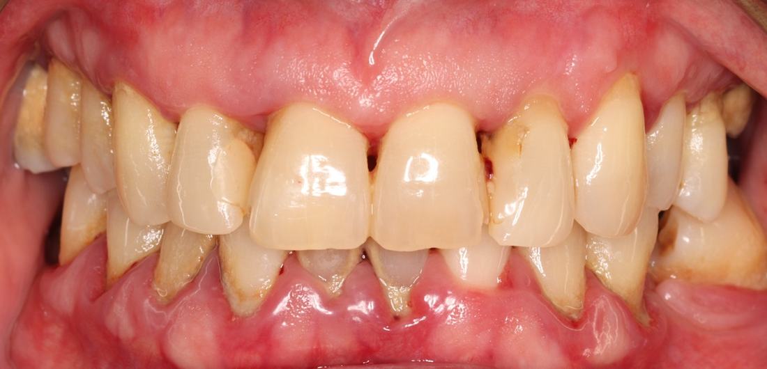 Non-Surgical Periodontal Therapy — before & after case 1