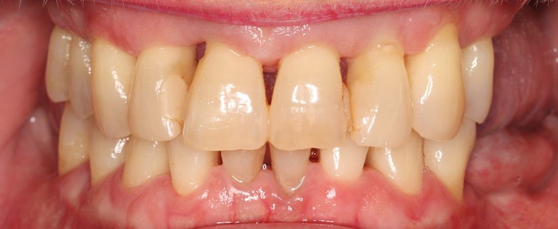Non-Surgical Periodontal Therapy — before & after case 2