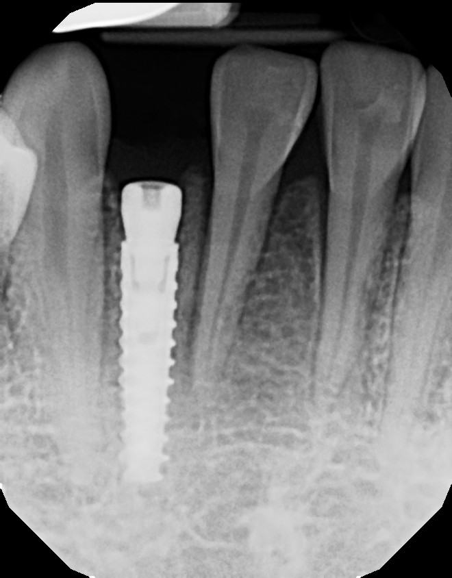 Precision Implant Placement with CBCT Technology — Case 1 — case 1