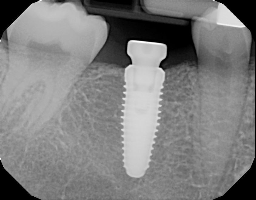 Precision Implant Placement with CBCT Technology — Case 2 — case 1