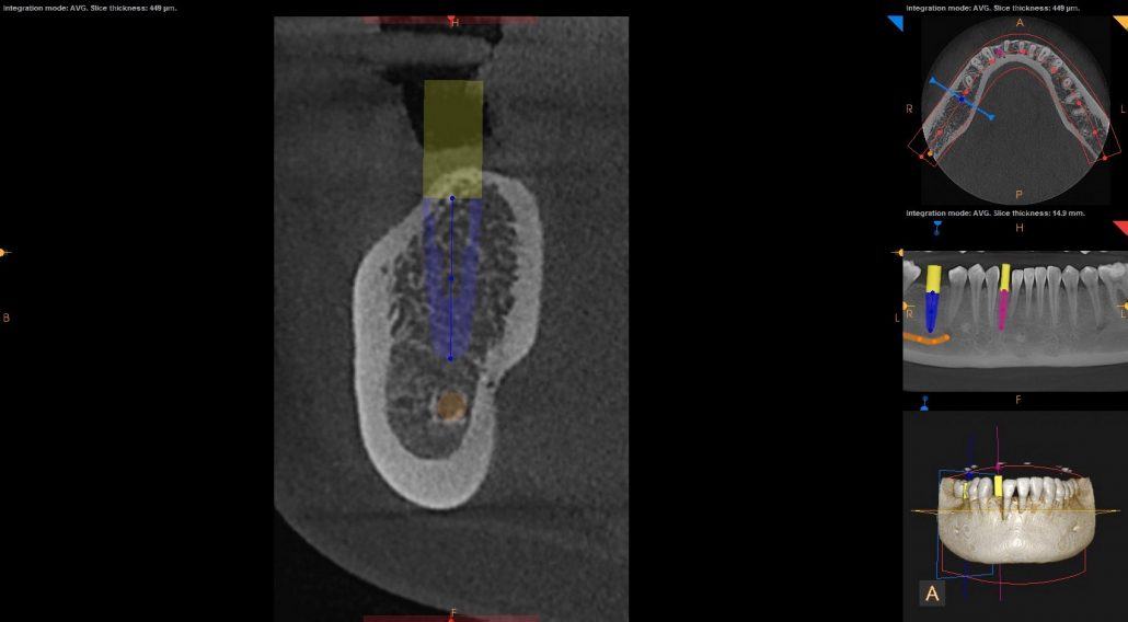 Precision Implant Placement with CBCT Technology — Case 2 — case 2
