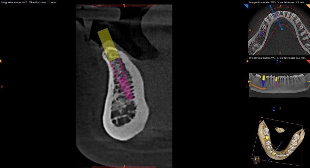 Precision Implant Placement with CBCT Technology — Case 1 — case 2