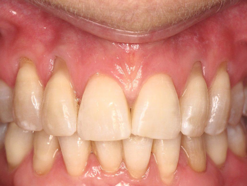 Root Coverage Procedures — Case 1 — case 1