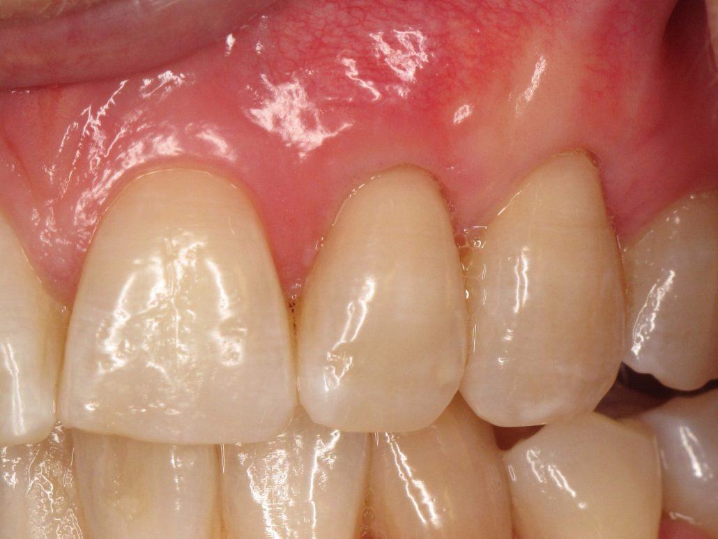 Root Coverage Procedures — Case 1 — case 2
