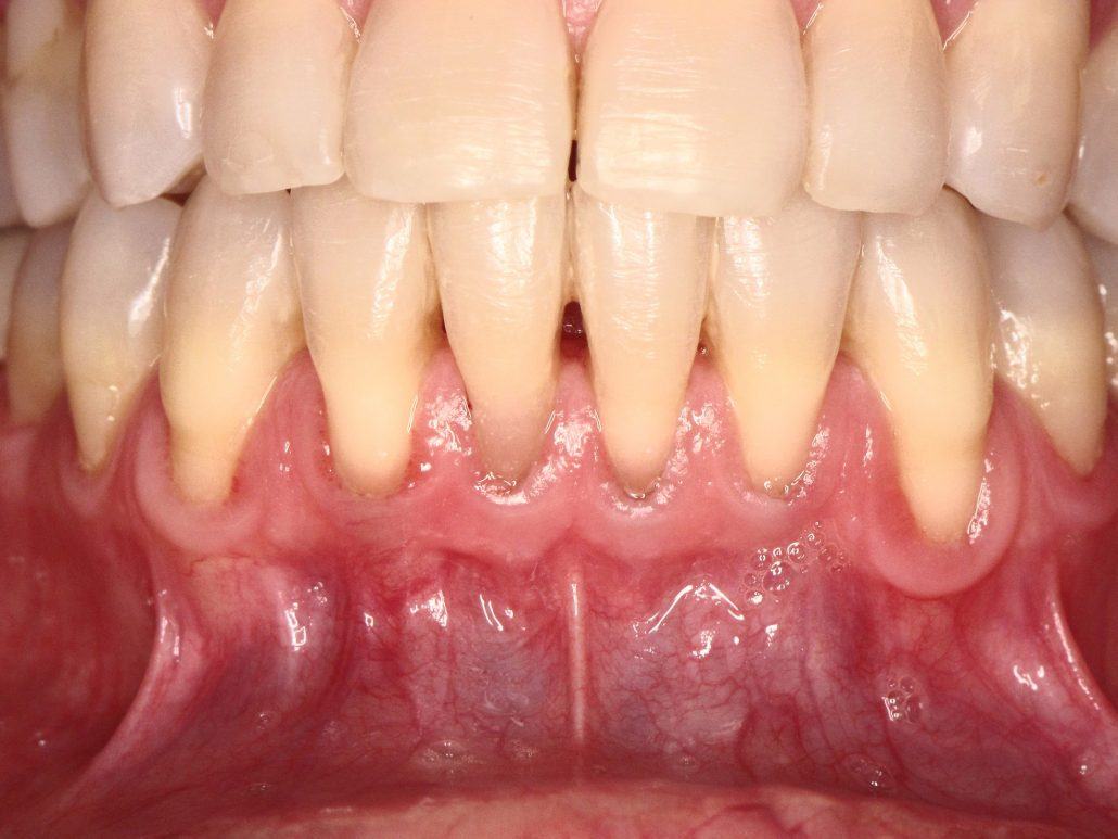 Root Coverage Procedures — Case 2 — case 1