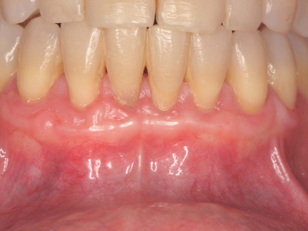 Root Coverage Procedures — Case 2 — case 2