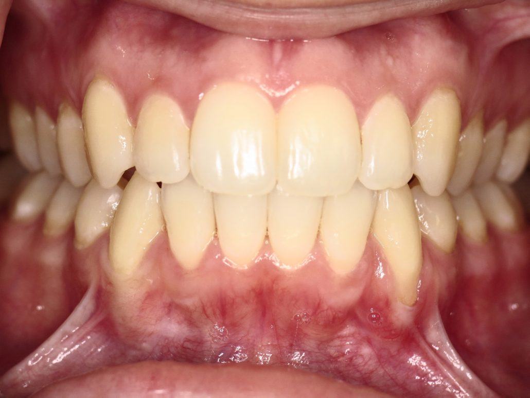 Root Coverage Procedures — Case 3 — case 1
