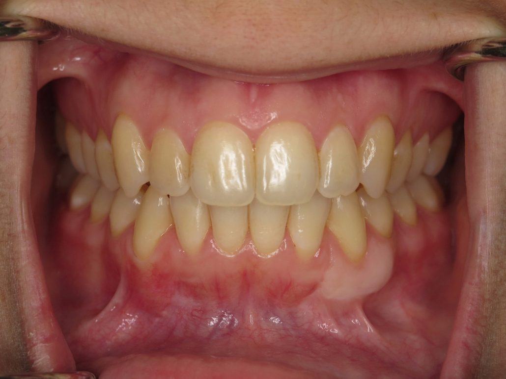 Root Coverage Procedures — Case 3 — case 2