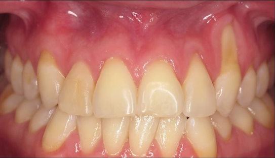 Root Coverage Procedures — Case 4 — case 1