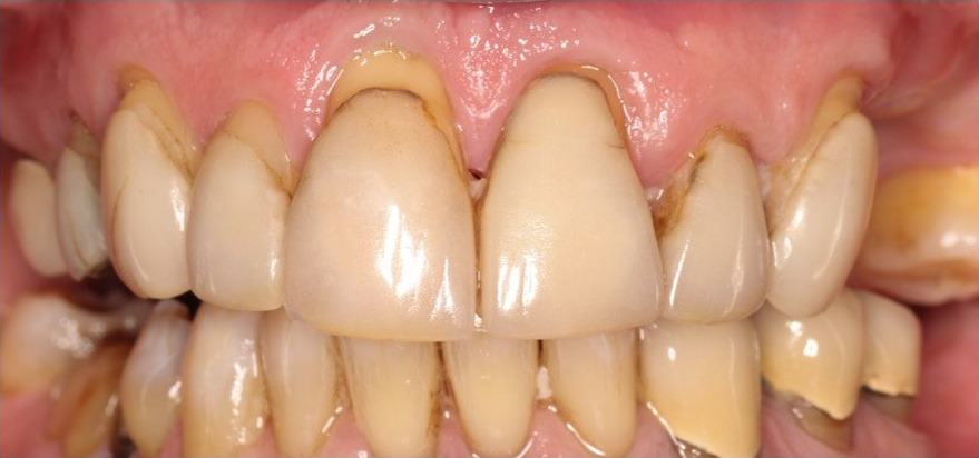 Root Coverage Procedures — Case 5 — case 1