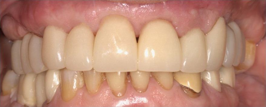 Root Coverage Procedures — Case 5 — case 2