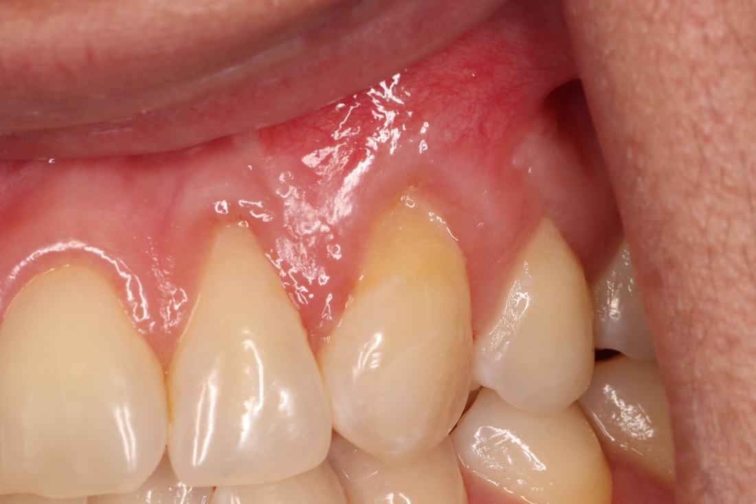 Root Coverage Procedures — Case 6 — case 2