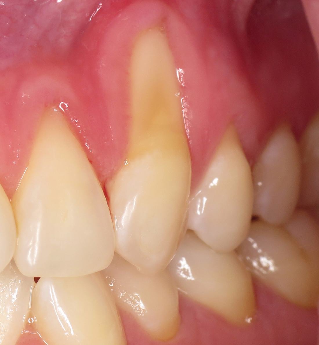 Root Coverage Procedures — Case 6 — case 1