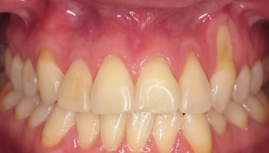 Gum Recession → Root Coverage — before