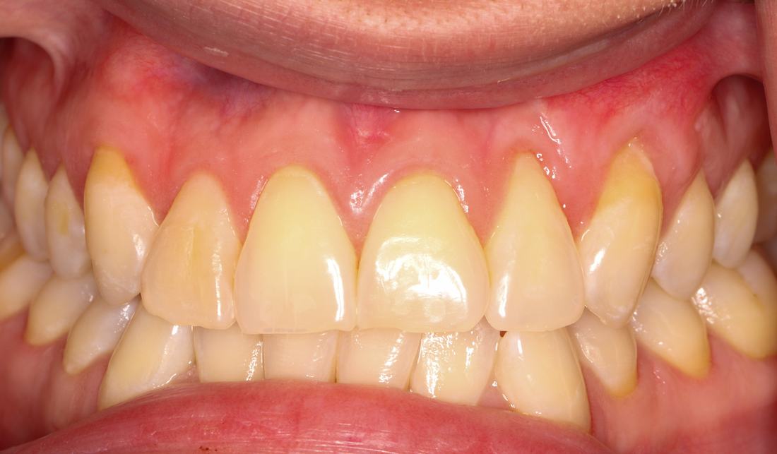 Gum Recession → Root Coverage — after
