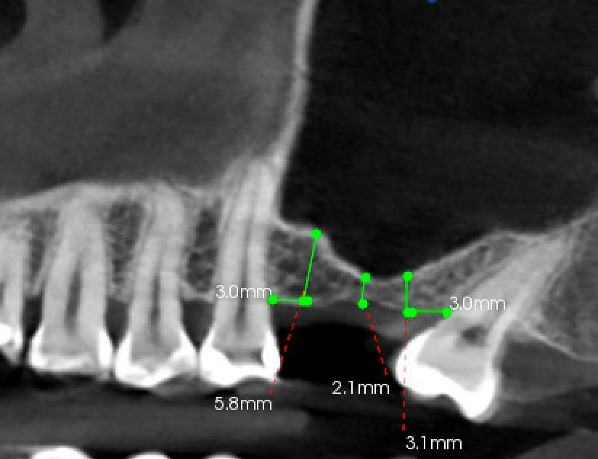 Sinus Grafting — Lateral Window Sinus Graft — case 1
