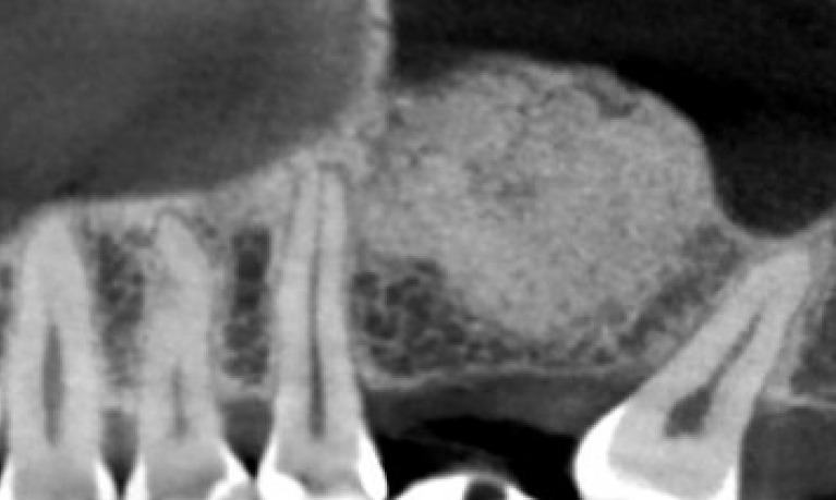 Sinus Grafting — Lateral Window Sinus Graft — case 2