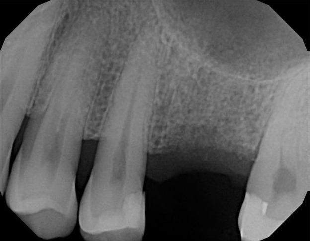 Sinus Grafting — Crestal Sinus Graft — case 1