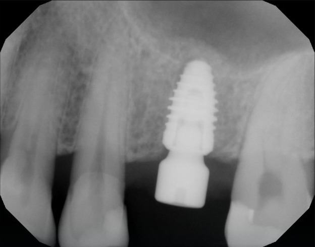 Sinus Grafting — Crestal Sinus Graft — case 2