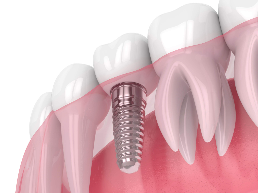 3D image of hollywood dental implants