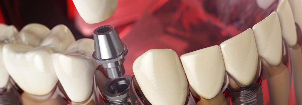 hollywood dental implants